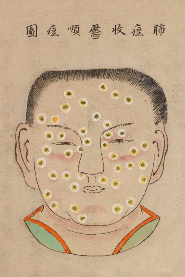 1720 Smallpox Illustration 7