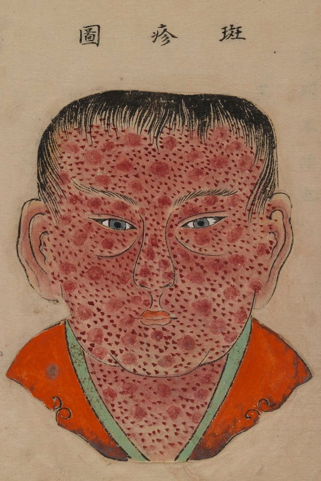1720 Smallpox Illustration 45