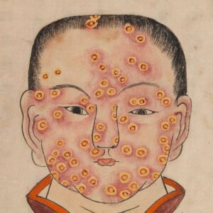 1720 Smallpox Illustration 1